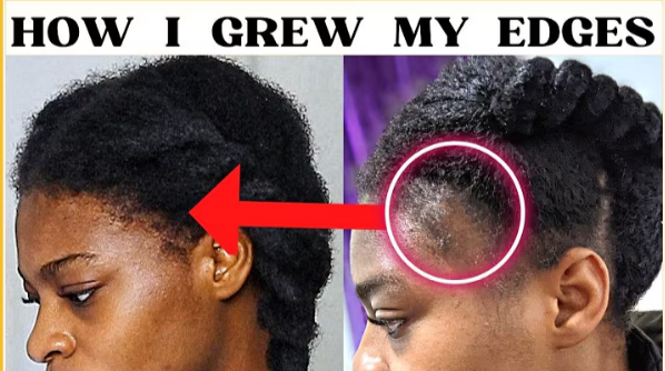 Hairline for Black Girls: A Guide to Hairline Care for Natural Hair